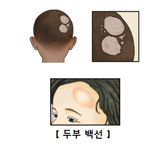 두부 백선