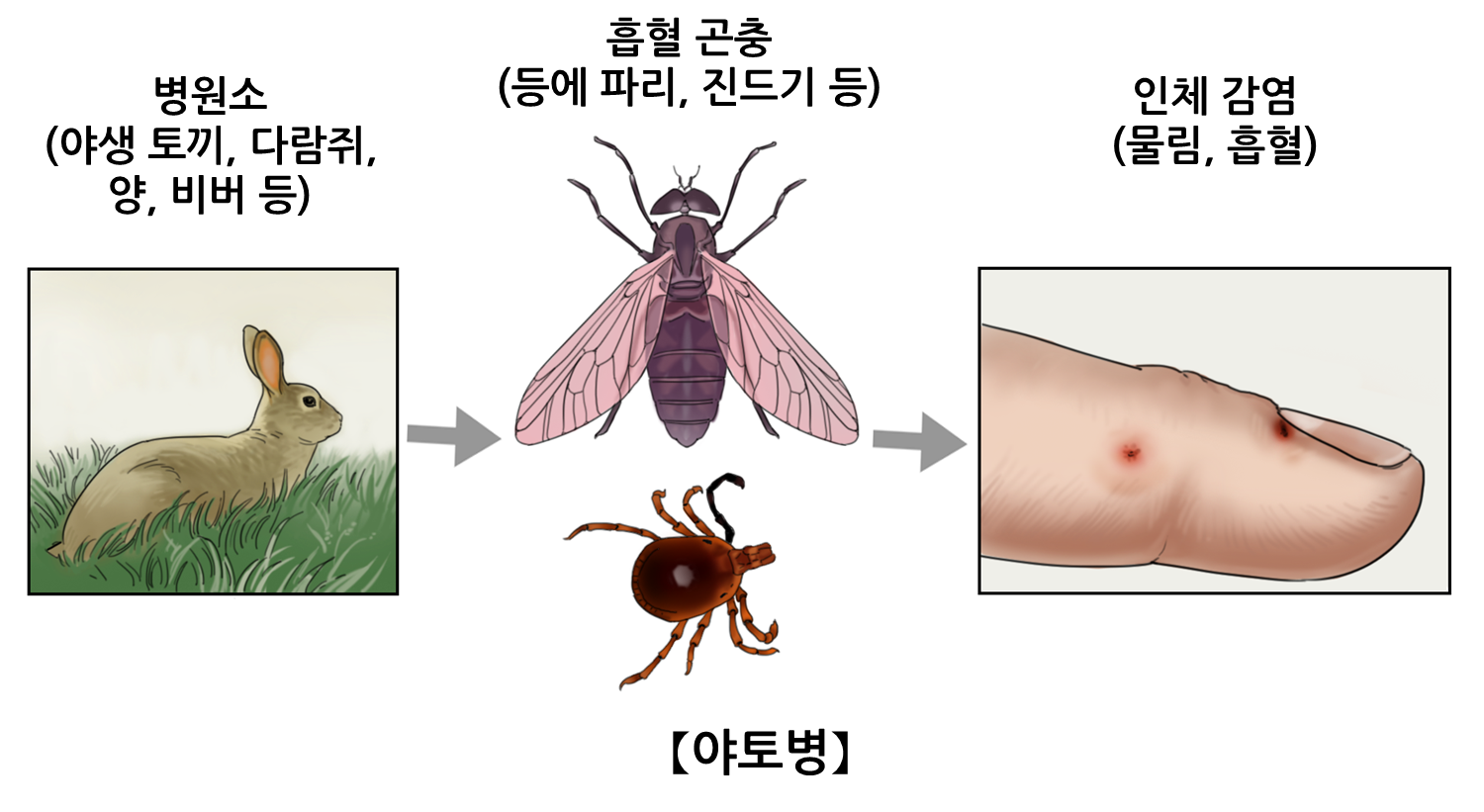 야토병